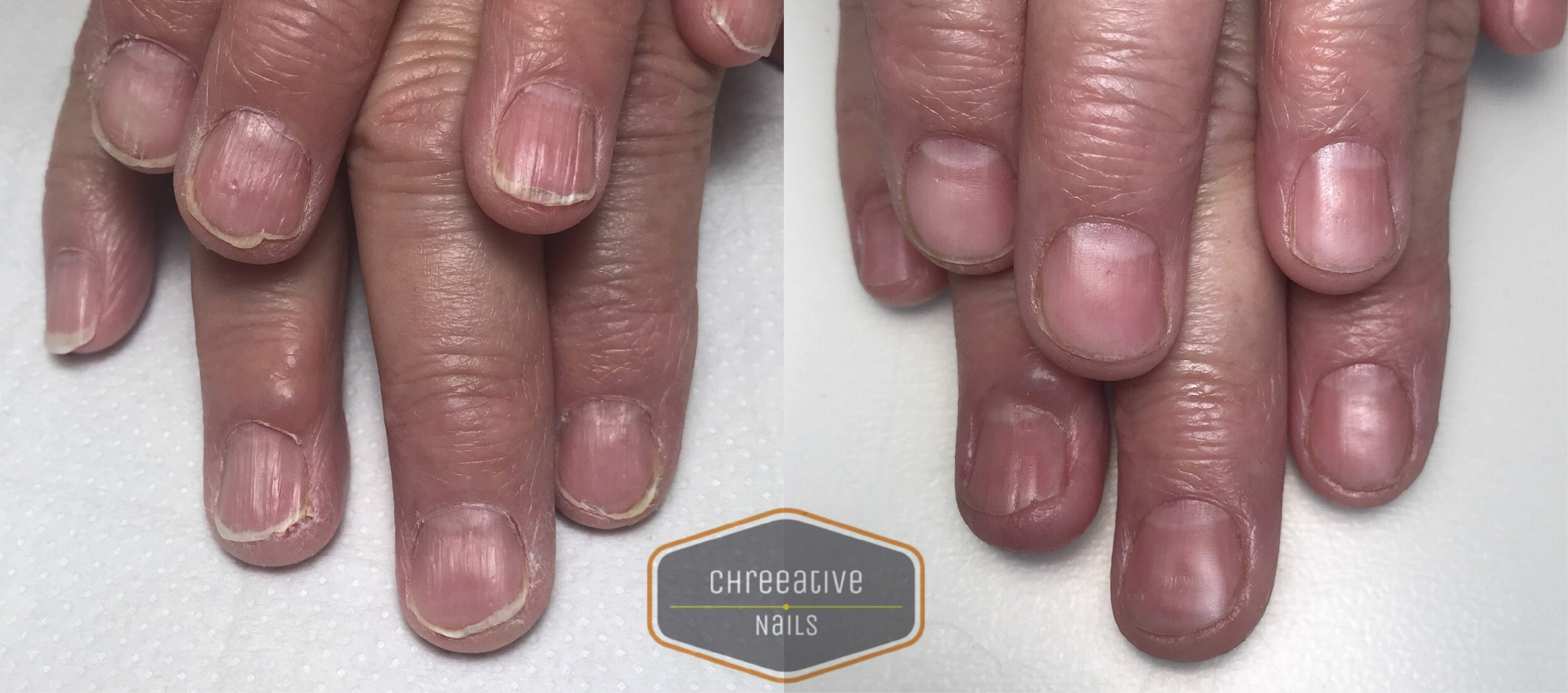This particular client suffers from severe ridging, splitting and peeling of the nails.