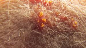 can mites on dogs affect humans