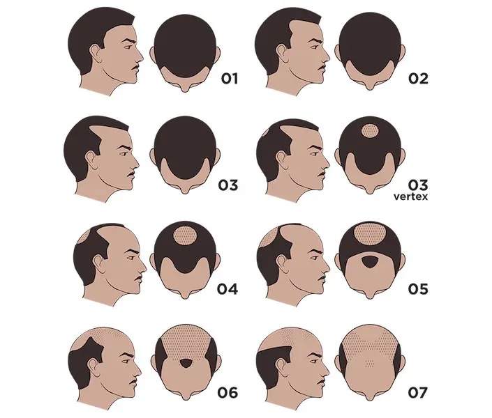 Ludwig's Scale for Women - Use Ludwigs Scale Chart For Hair Loss